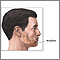Chin augmentation- series