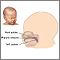 Cleft lip repair- series
