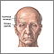 Forehead lift- series