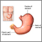 Gastrectomy- series