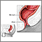 Hemorrhoid surgery- series