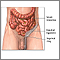 Inguinal hernia repair- series