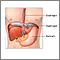 Hiatal hernia repair- series