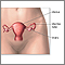 Hysterectomy- series
