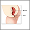 Imperforate anus repair- series