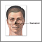 Septoplasty- series