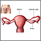 Tubal ligation- series