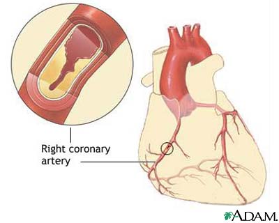 Coronary artery disease
