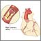 Coronary artery disease