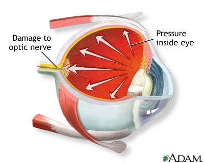 Glaucoma