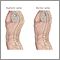 Kyphosis