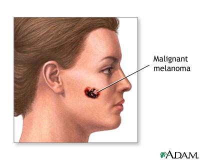 Malignant melanoma