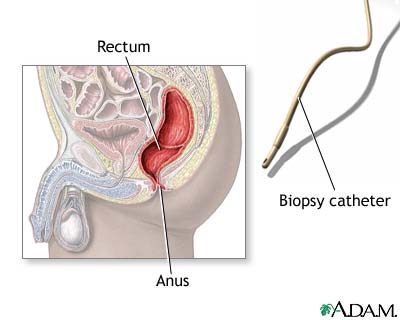 Anal biopsy