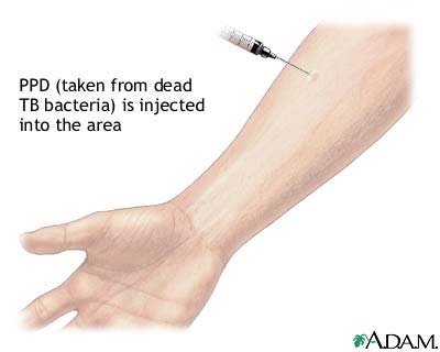 PPD skin test