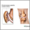 Runners knee
