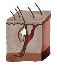 Hair transplantation as way of fight with hair loss. Hair care.