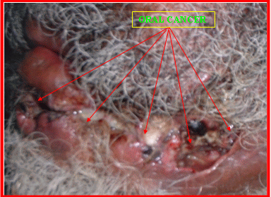 oral cancer