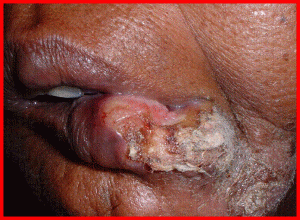 oral cancer