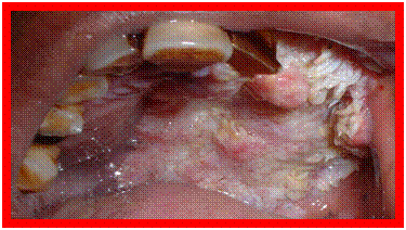 oral cancer