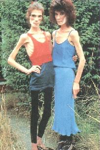 hermanas anorexicas