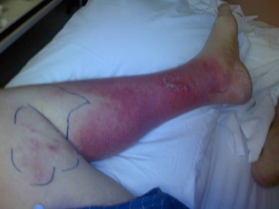 Percival's bad leg