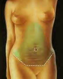 Skin Separation