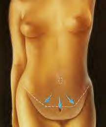 Skin Flap Stretched Down