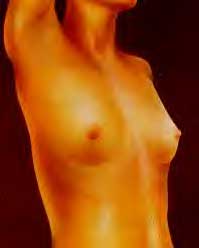 Breasts before surgery