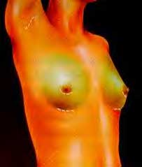 Diagram of concealed breast surgery scars