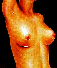 Breasts after surgery