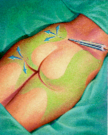 Cannula inserted in the skin