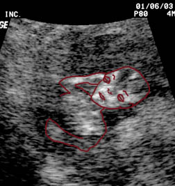 Drawing of Fetus