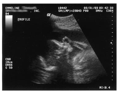 My Baby's Profile with hand at 24 weeks