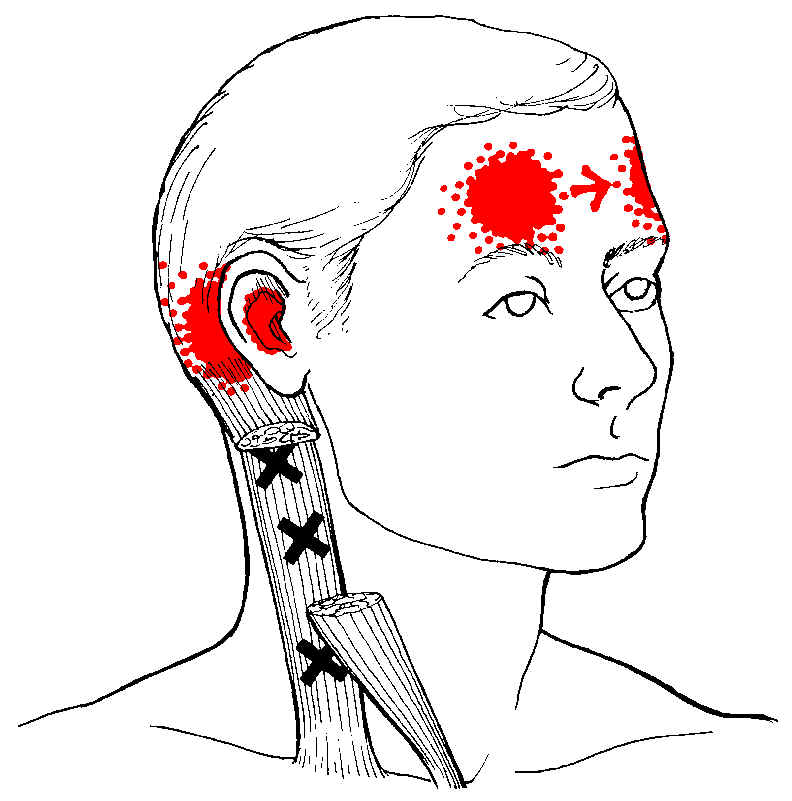 Massage helps these headache trigger points.