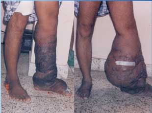 Two views showing an elephentiasis patient after and before treatment