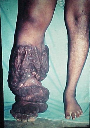 View of limb before a Shunt Procedure