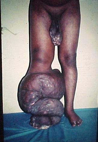 View of Limb after a Shunt procedure