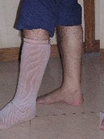 Bandaging or Stockings are mandatory