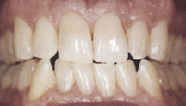 teeth whitening before