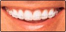 Clear Ceramic Braces