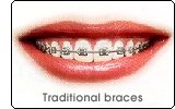 Traditional Braces