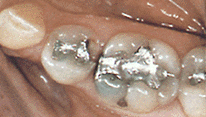 porcelain onlays befor