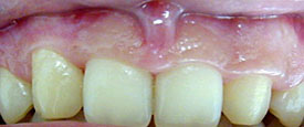 before dental implant