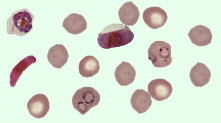 Blood film