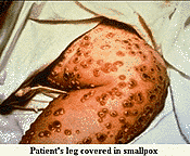 smallpox_picture_1