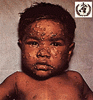 smallpox_picture_4