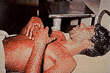 smallpox_picture_5