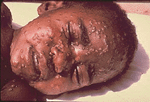smallpox_picture_6