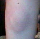 it's my arm. yes. and it's only ONE mosquito bite. only one. not ten, one.