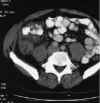 appendeculitis_fig1.jpg (33681 bytes)